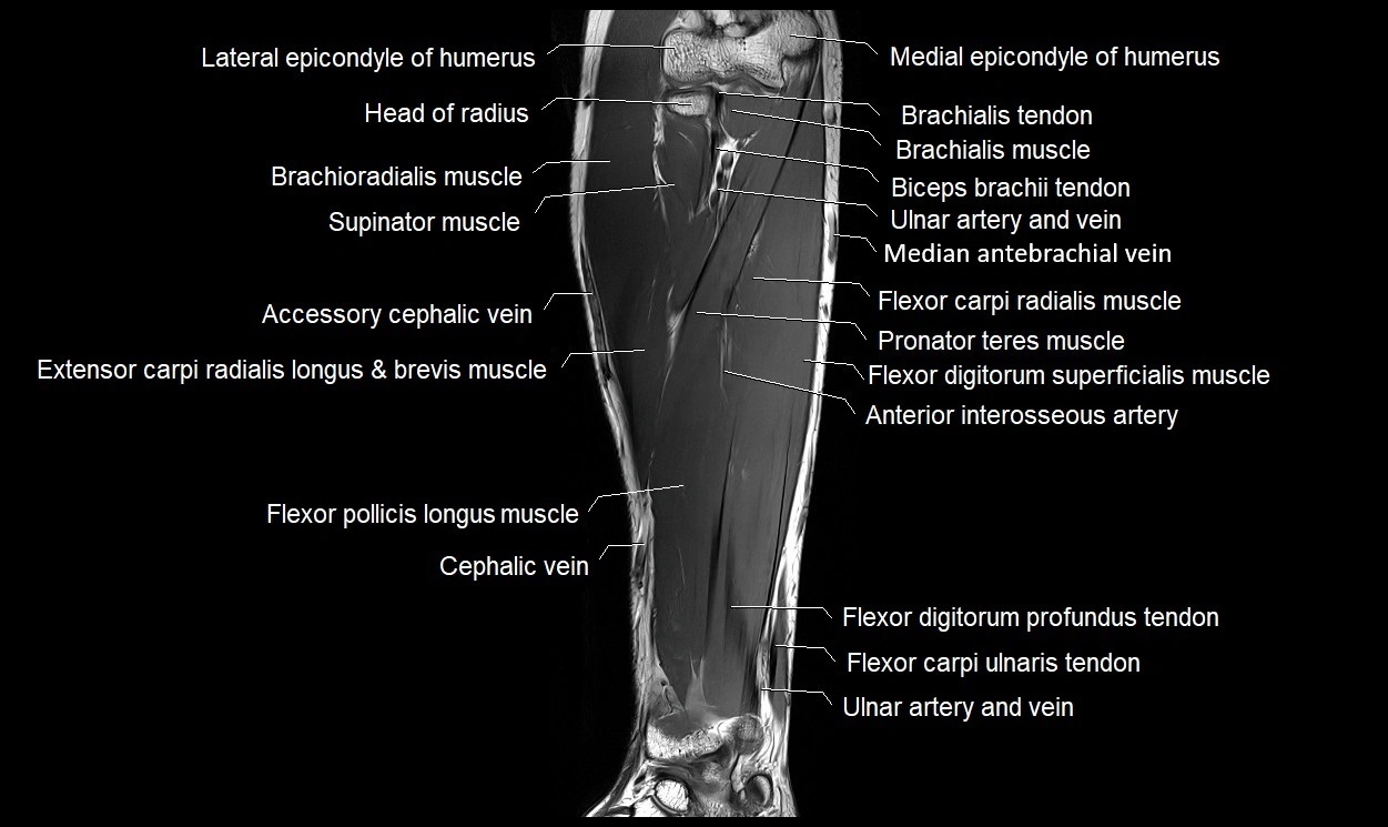 MRI 3T forearm coronal cross sectional anatomy image 11.webp